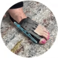 Frena el avance del juanete